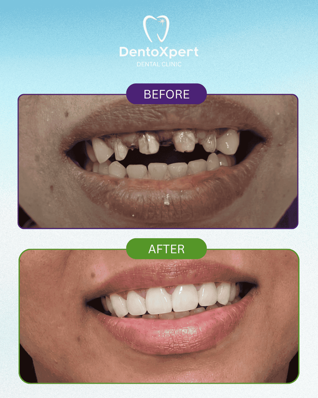Before and after dental treatment result at DentoXpert Dental Clinic in Thane